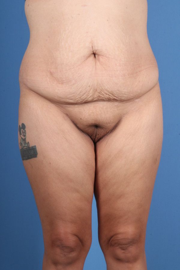Body Lift Before & After Image