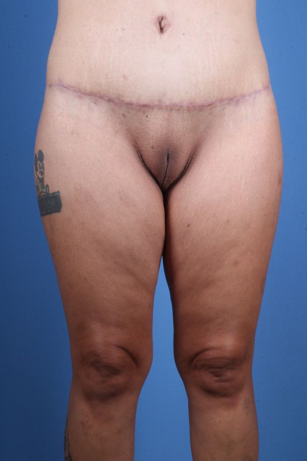 Body Lift Before & After Image