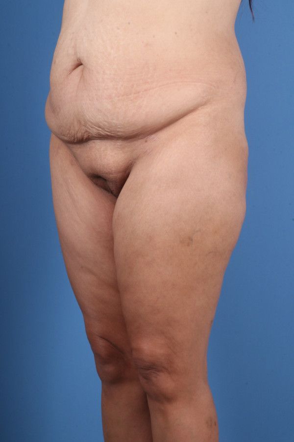 Body Lift Before & After Image