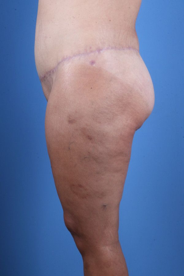 Body Lift Before & After Image