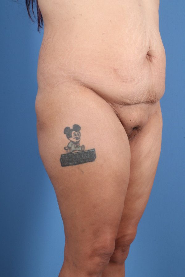 Body Lift Before & After Image