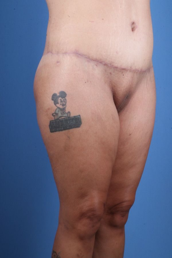 Body Lift Before & After Image