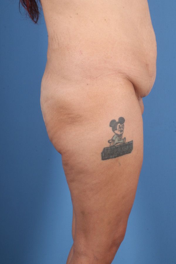 Body Lift Before & After Image