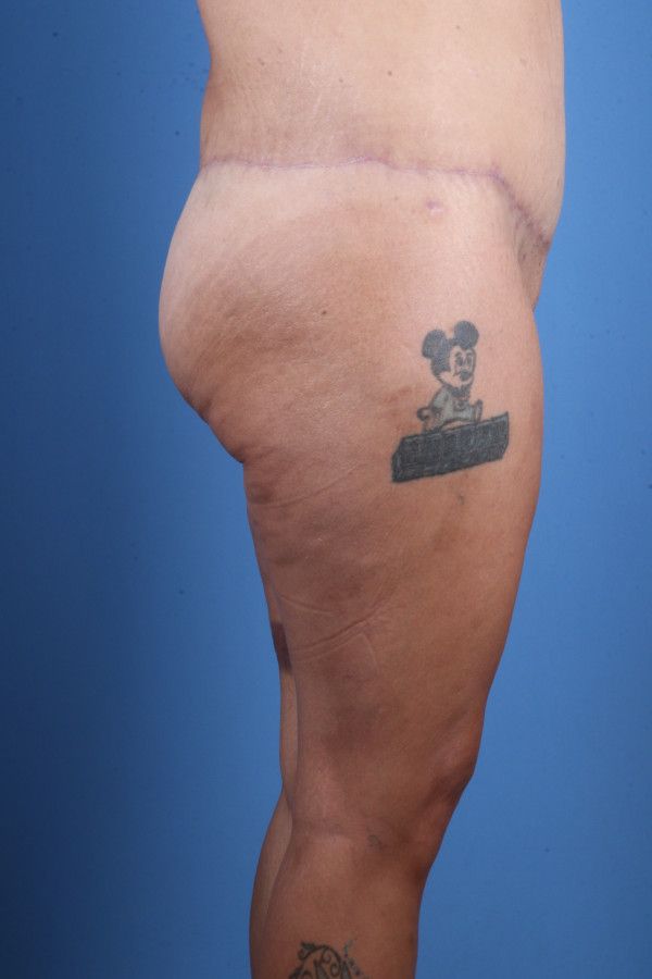 Body Lift Before & After Image