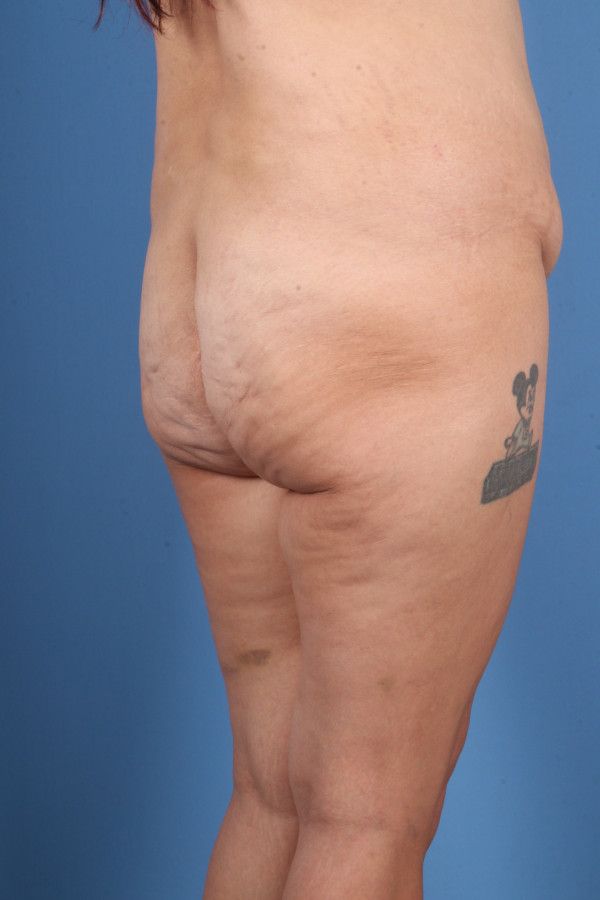 Body Lift Before & After Image