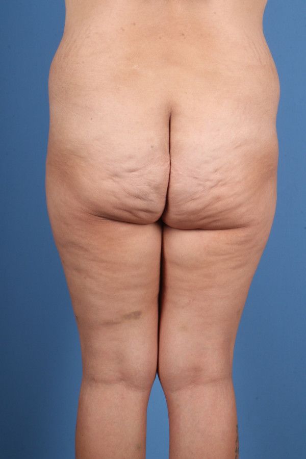 Body Lift Before & After Image