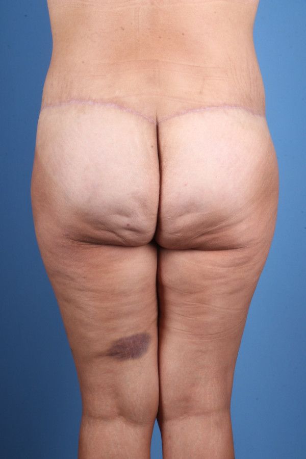 Body Lift Before & After Image
