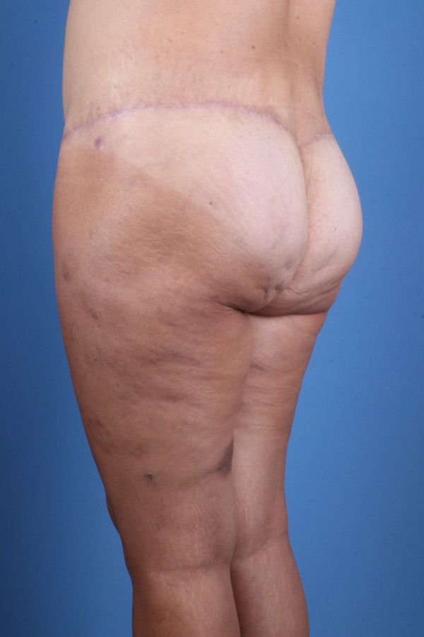 Body Lift Before & After Image