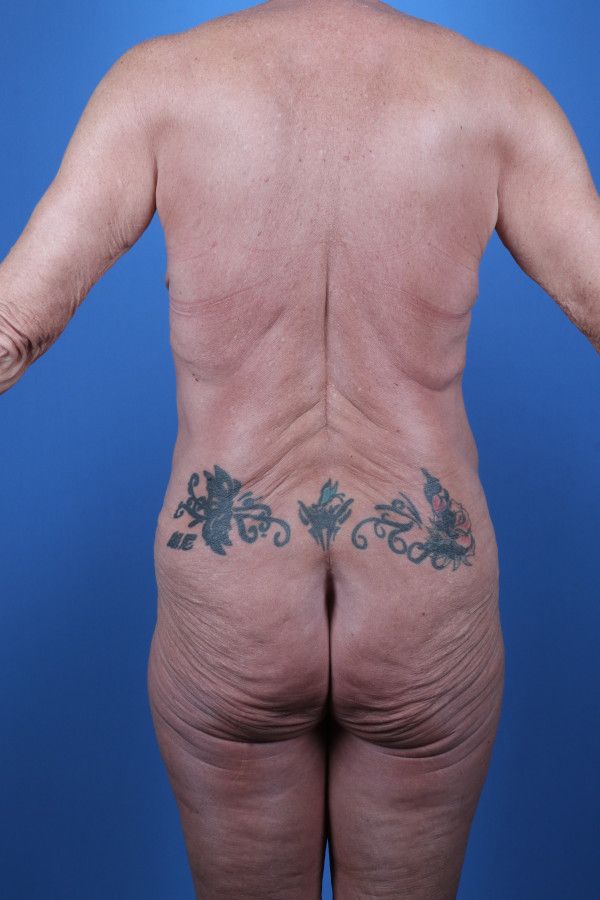 Body Lift Before & After Image