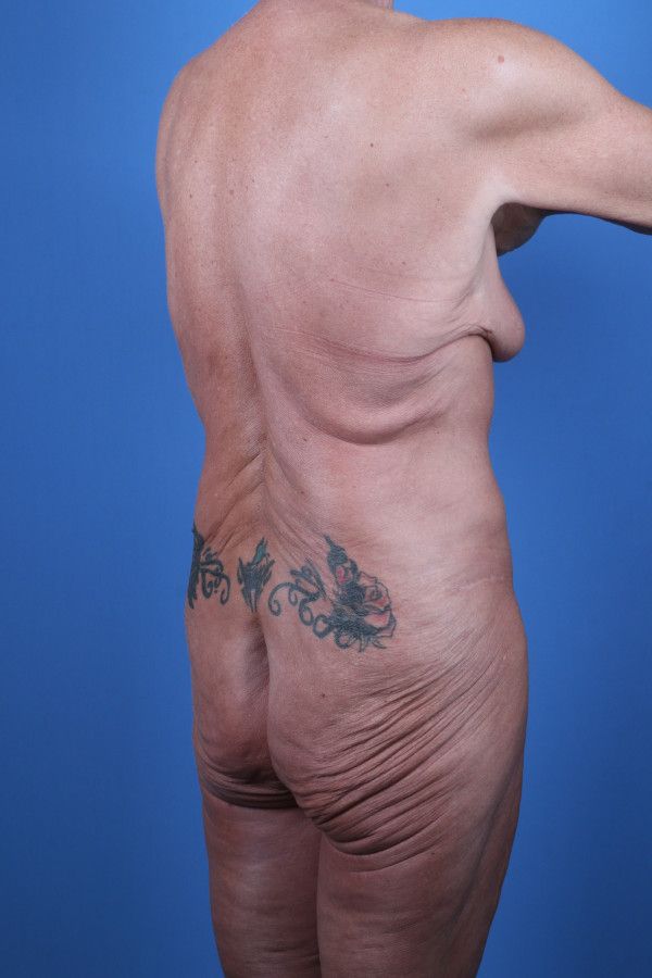 Body Lift Before & After Image