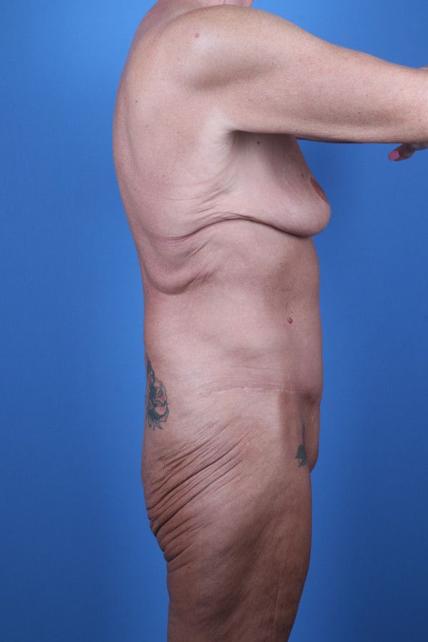 Body Lift Before & After Image