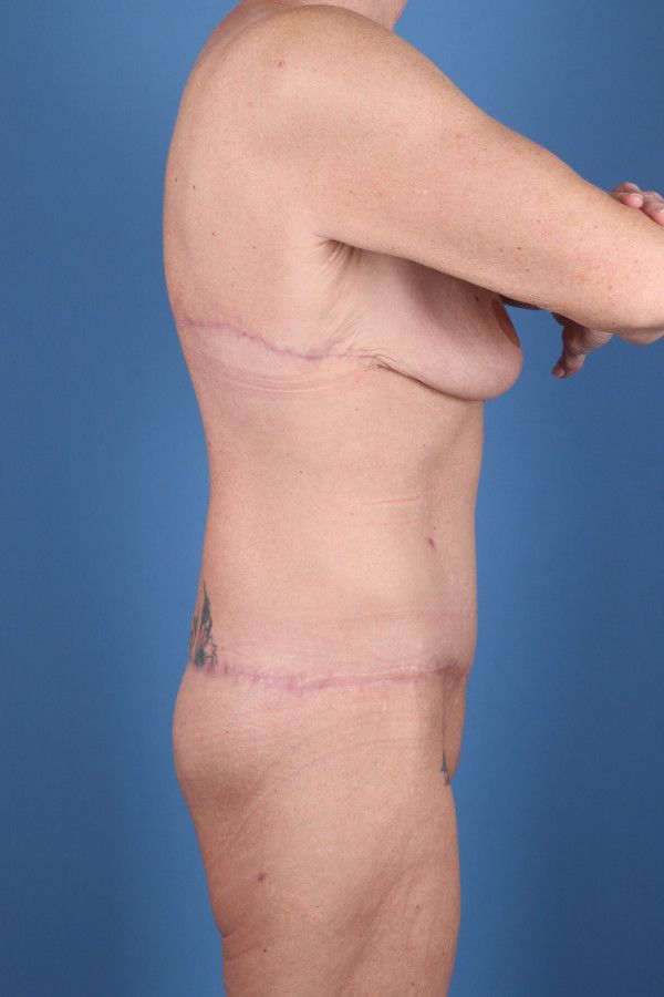 Body Lift Before & After Image
