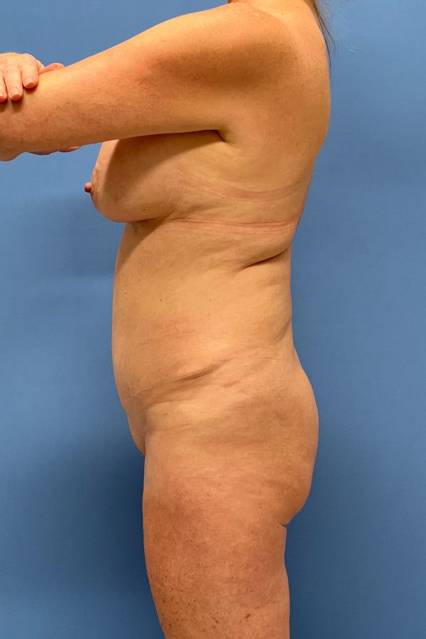 Body Lift Before & After Image