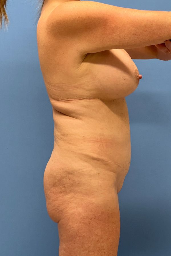 Body Lift Before & After Image