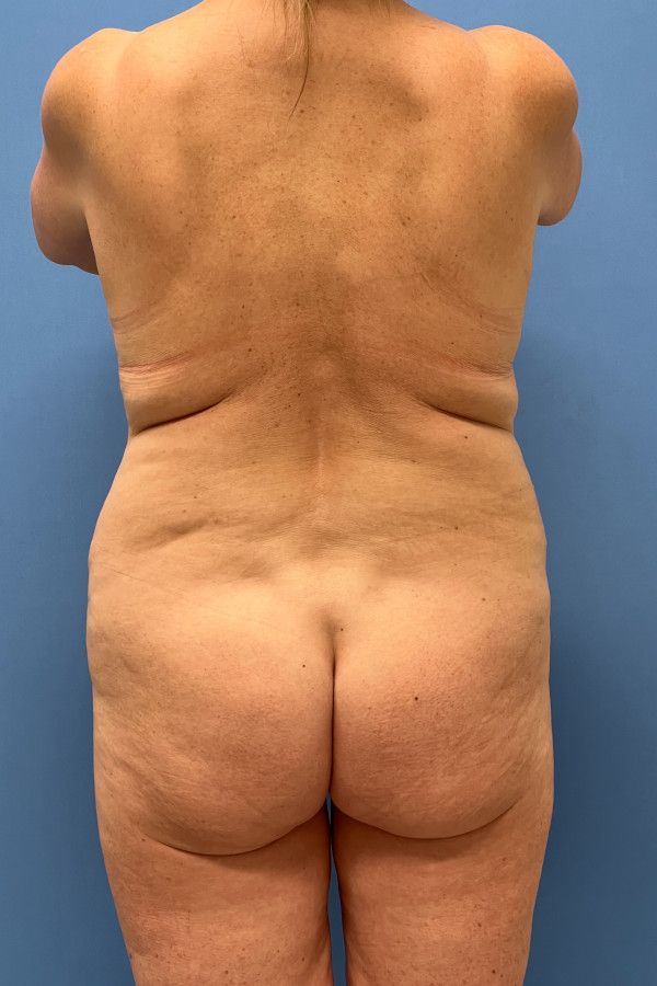 Body Lift Before & After Image