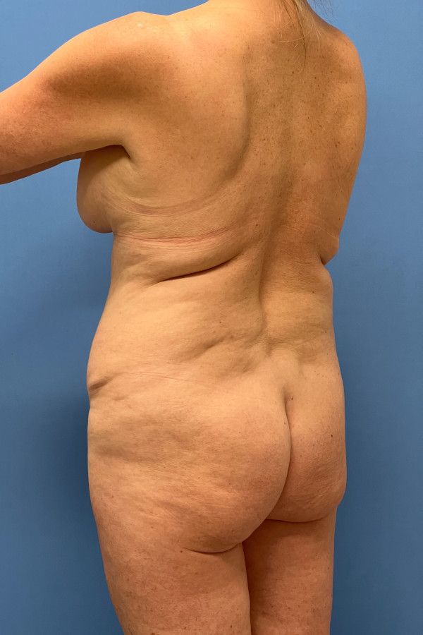 Body Lift Before & After Image