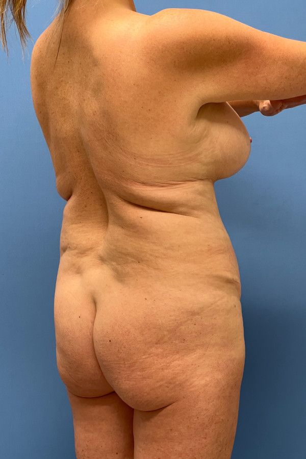 Body Lift Before & After Image