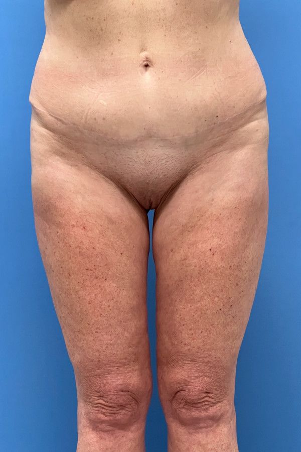 Body Lift Before & After Image