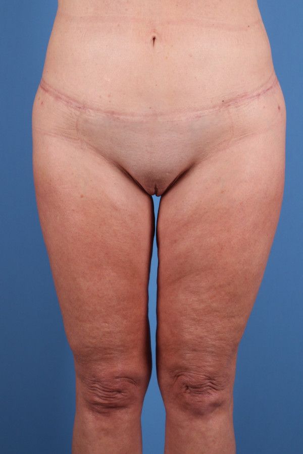 Body Lift Before & After Image