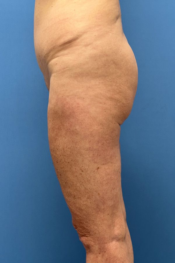 Body Lift Before & After Image