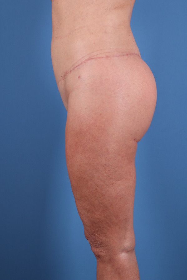 Body Lift Before & After Image