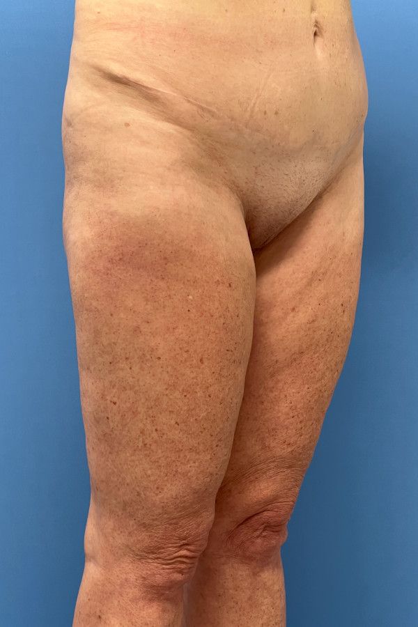 Body Lift Before & After Image