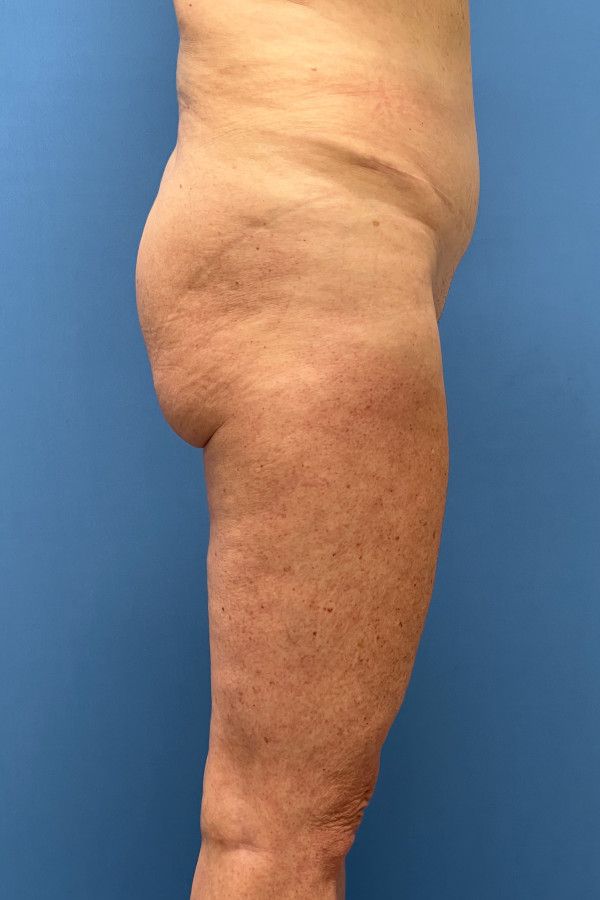 Body Lift Before & After Image