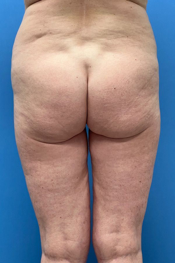 Body Lift Before & After Image
