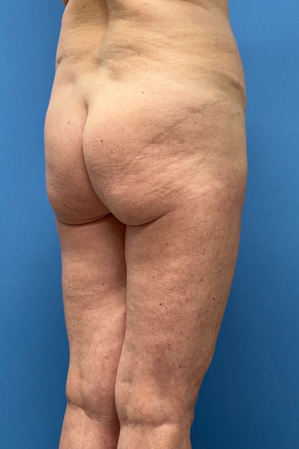 Body Lift Before & After Image