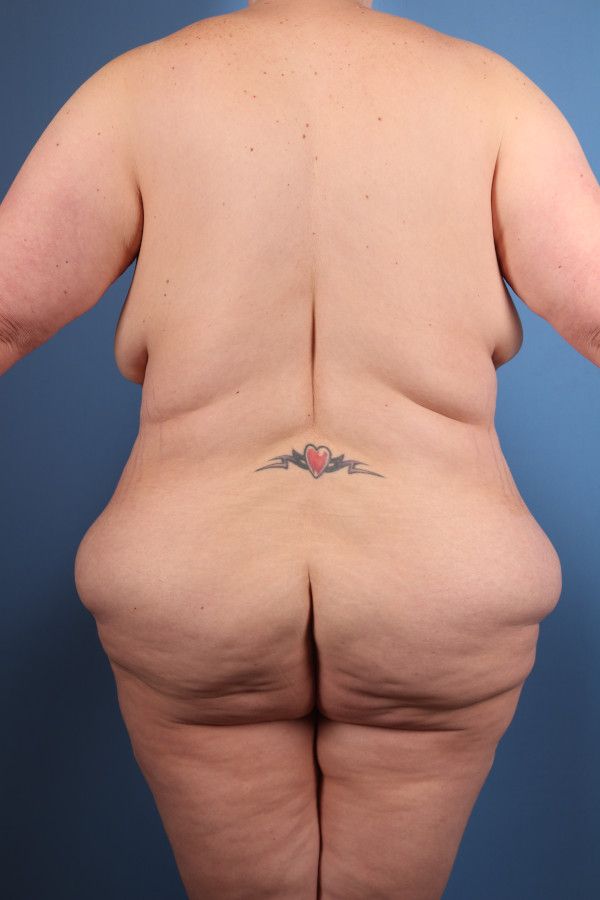 Body Lift Before & After Image