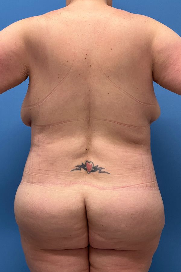 Body Lift Before & After Image