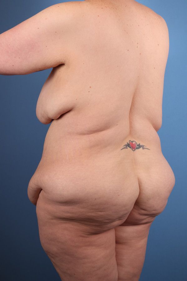 Body Lift Before & After Image