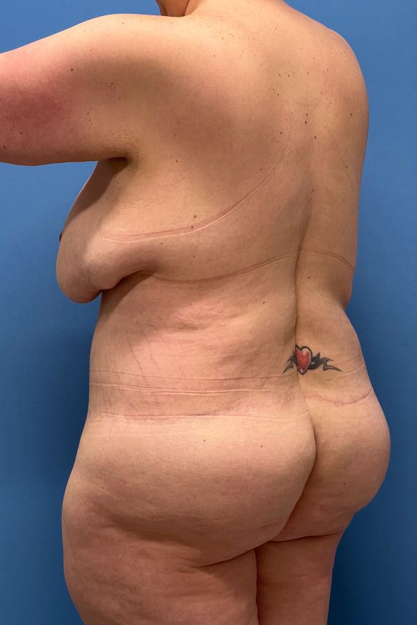Body Lift Before & After Image