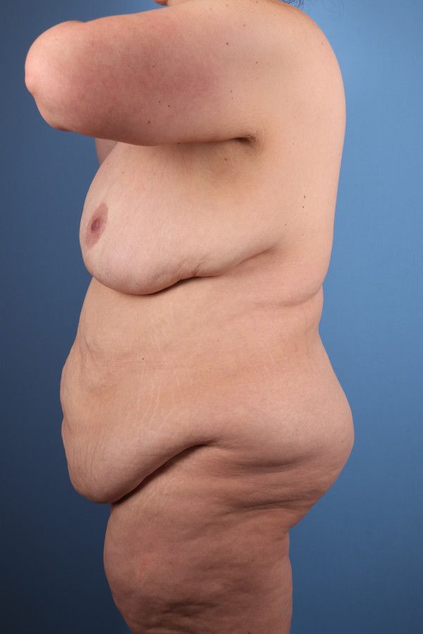 Body Lift Before & After Image