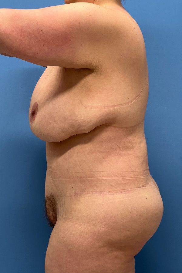 Body Lift Before & After Image