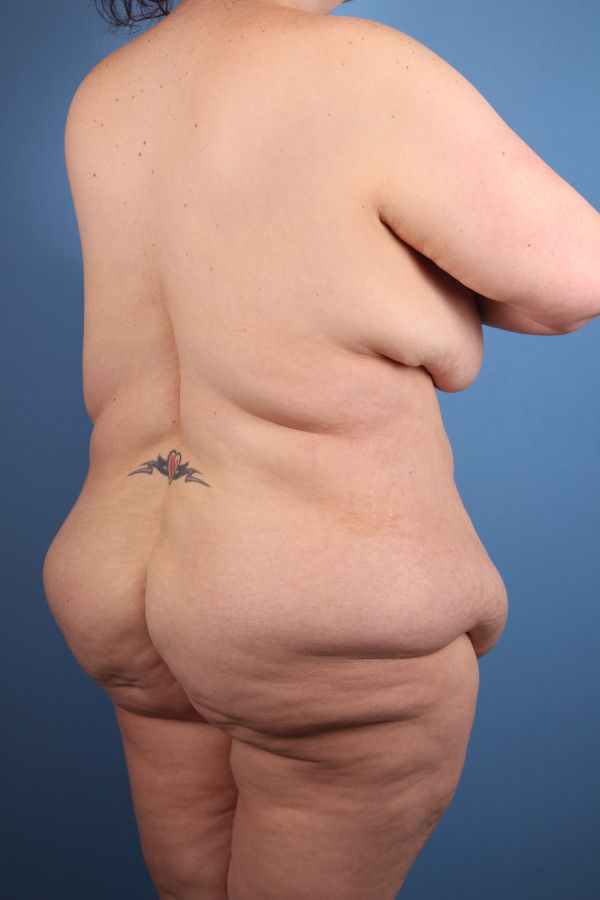 Body Lift Before & After Image