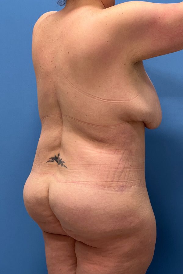 Body Lift Before & After Image