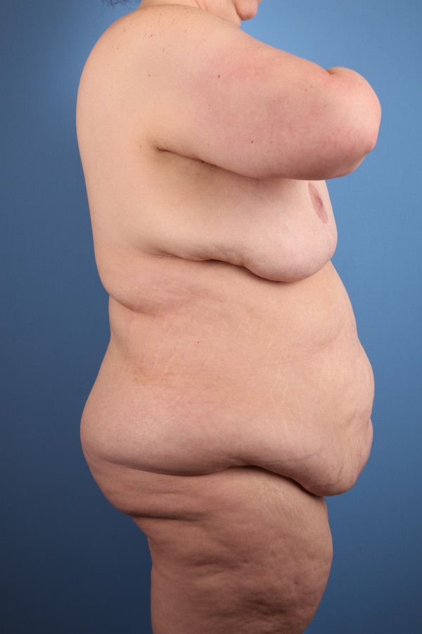 Body Lift Before & After Image