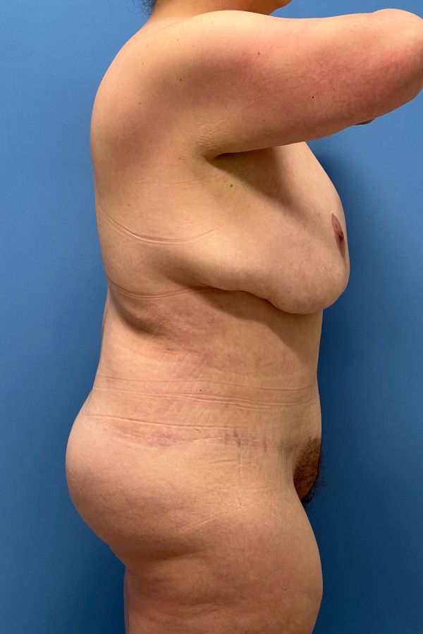 Body Lift Before & After Image