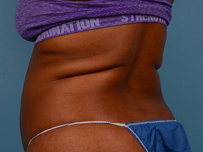 Tummy Tuck Before & After Image