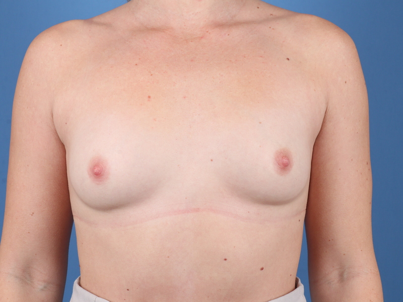 Breast Augmentation Before & After Image