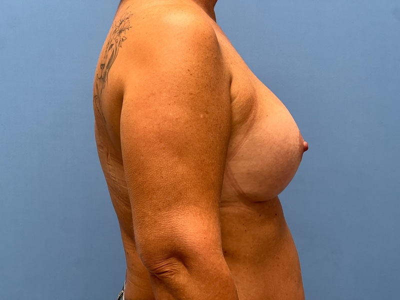 Breast Augmentation Before & After Image