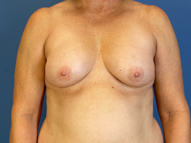 Breast Augmentation Before & After Image