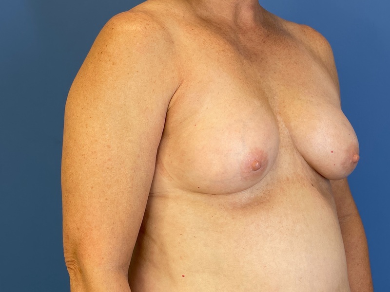 Breast Augmentation Before & After Image