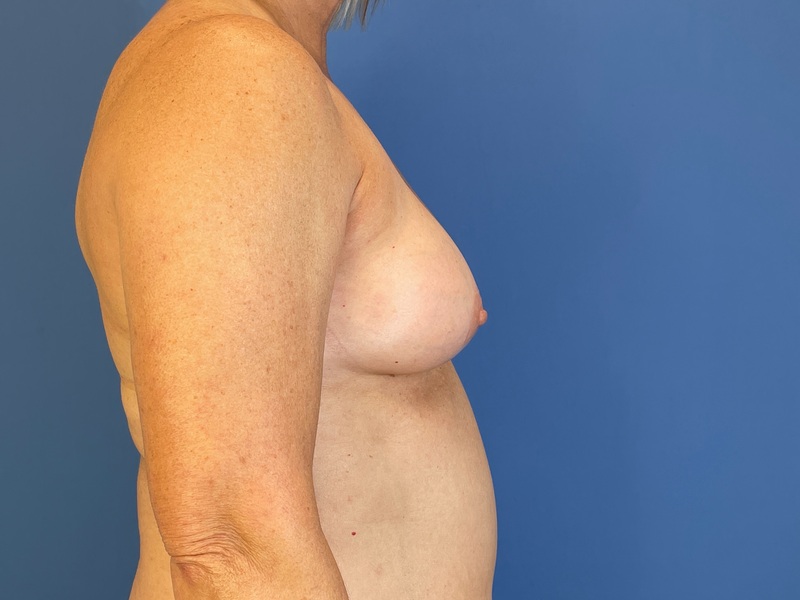 Breast Augmentation Before & After Image