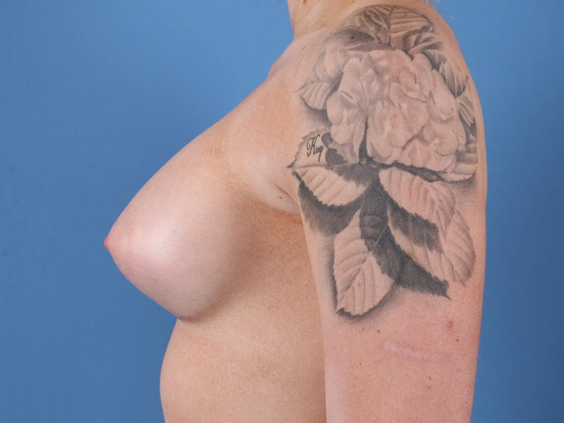 Breast Augmentation Before & After Image