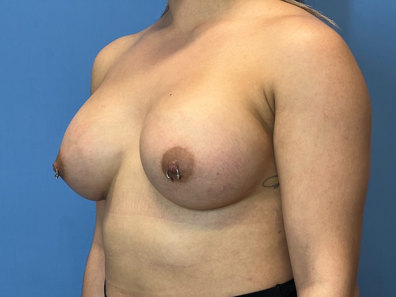 Breast Augmentation Before & After Image