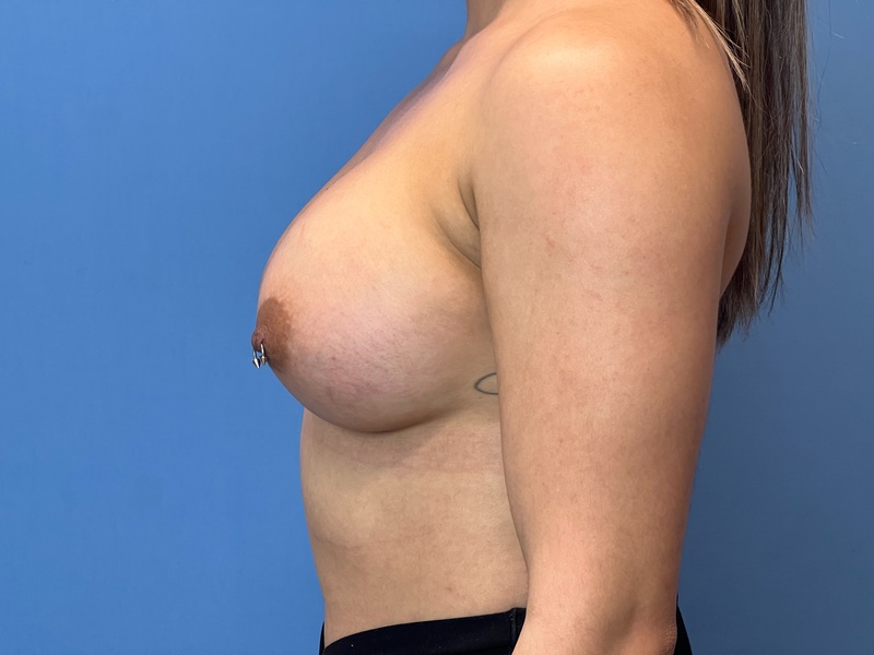 Breast Augmentation Before & After Image