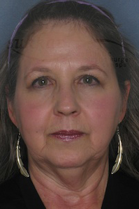 Facelift Before & After Image