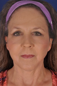 Facelift Before & After Image